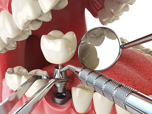 Best Emergency Wisdom Tooth Extraction in Moore Haven, FL